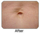 After Cutera Titan Skin Tightening