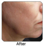 After Cutera Titan Skin Tightening Procedure