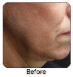 Before Cutera Titan Skin Tightening Procedure